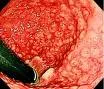 Lymphogranuloma venerum