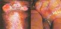 Granuloma ingvinale