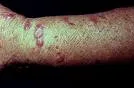 Sporotrihoza