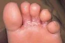 Dermatofitije (Dermatophytosis)