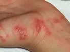 Šuga (Scabies)