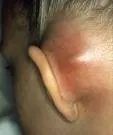 Akutni mastoiditis
