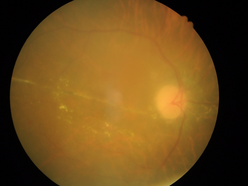 Okluzija ili tromboza centralne retinalne vene