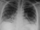 Pneumocistoza