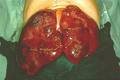 Hepatoblastom