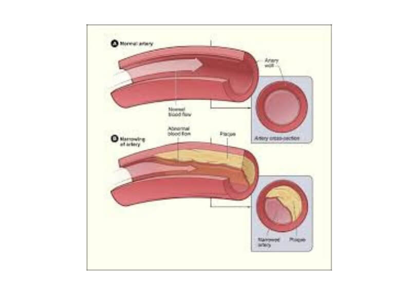 Obliterantna arterioskleroza