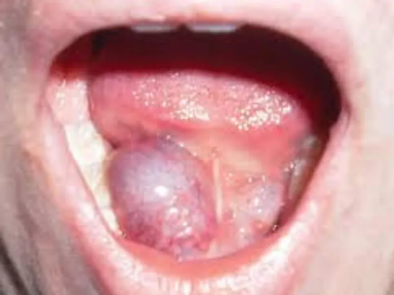 Sublingvalna cista (Ranula)