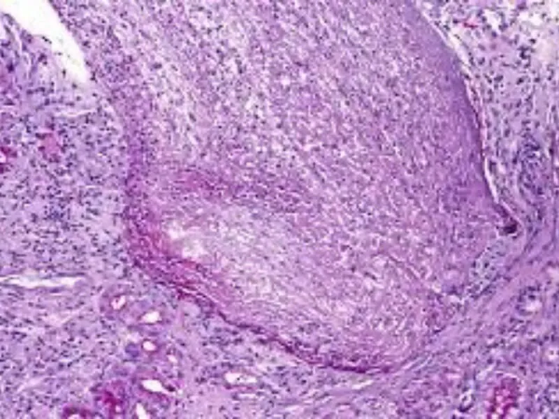 Akutni duodenitis