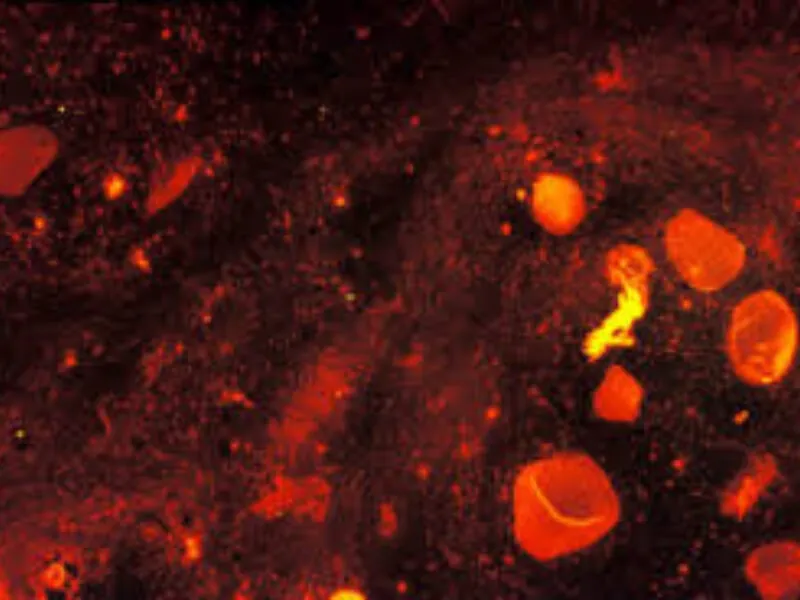 Tuberkulozni peritonitis