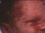 Autosenzitivni dermatitis