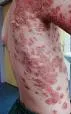 Impetigo bullosa