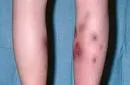 Erythema nodosum