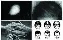 Effluvium telogenes