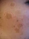 Chloasma