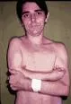 Anhidroza