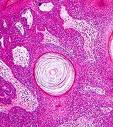 Seboroične bradavice (Keratosis seborrhoica)