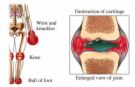 Poliartritis
