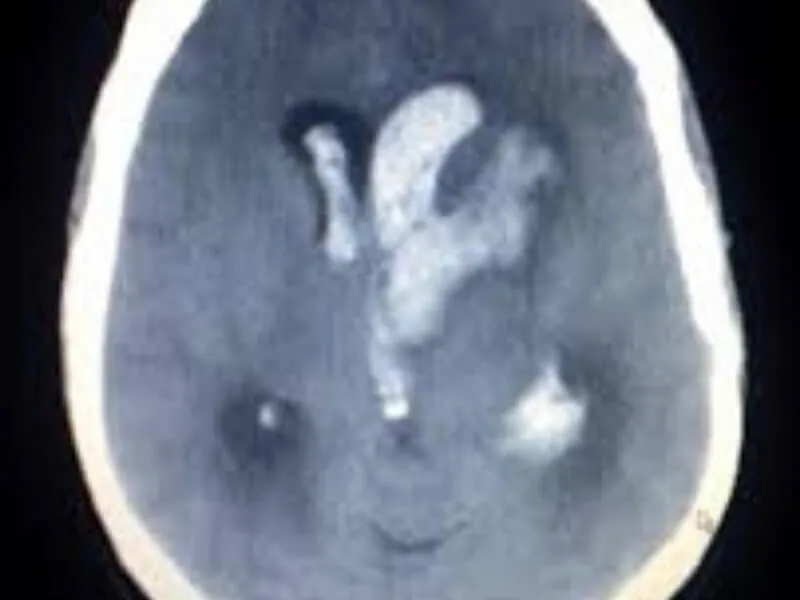 Intracerebralno krvarenje