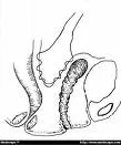 Vaginalna enterokela