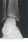 Osteohondroza