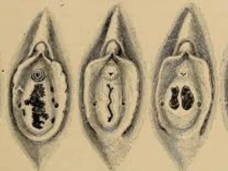 Hymen imperforatus
