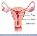 Endometrijalni polip