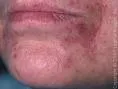 Perioralni dermatitis