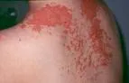 Atrofična vaskularna poikiloderma