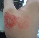 Iritacioni kontaktni dermatitis