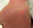 Eksfolijativni dermatitis