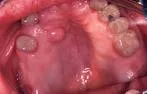 Neurofibrom