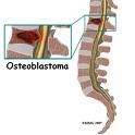Osteoblastom