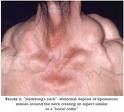 Lipoblastomatoza