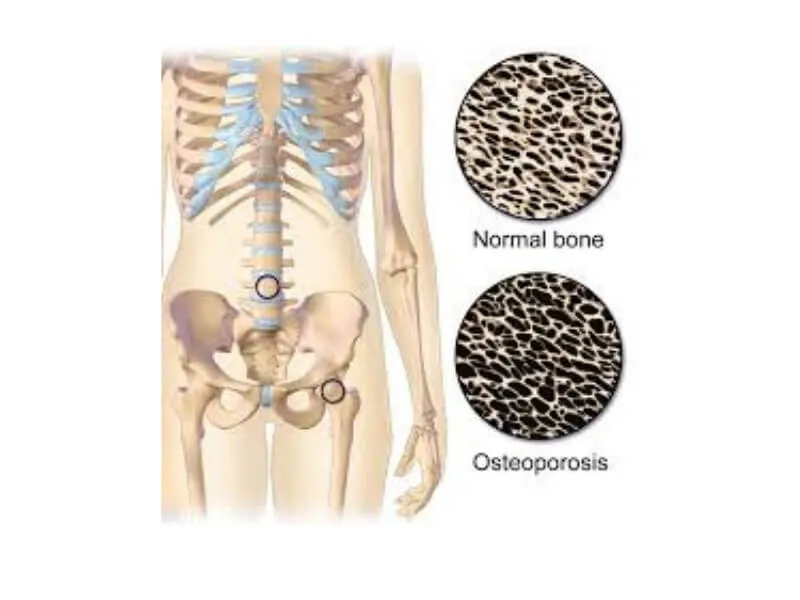 Osteoporoza - tiha, ali uporna bolest