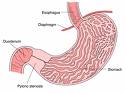 Infantilna hipertrofična stenoza pilorusa