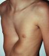 Pectus excavatum