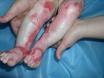 Bulozna epidermoliza