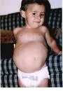Prune Belly sindrom