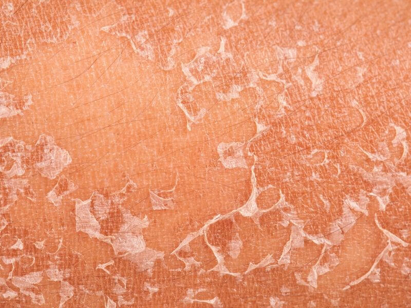 Atopski dermatitis