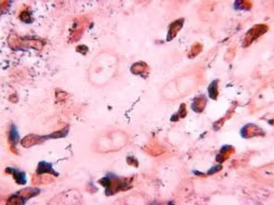 Treponema carateum