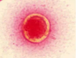 Rhinosporidium seeberi 