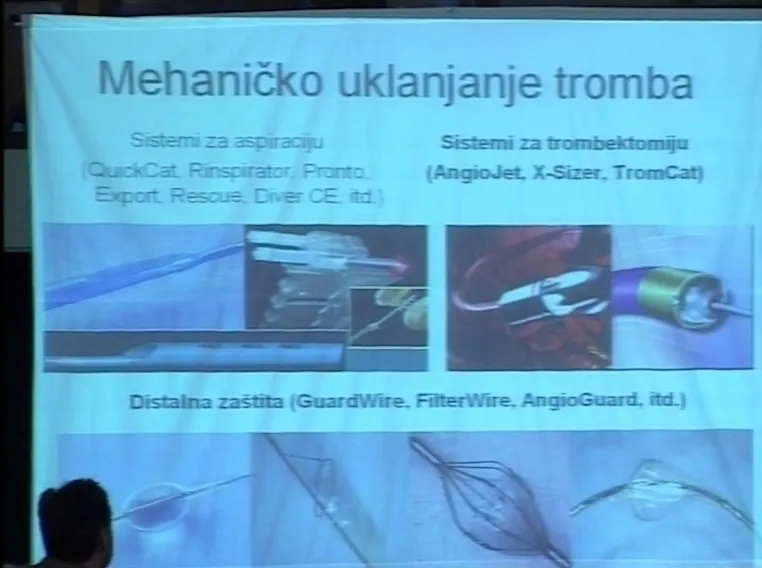 Spasavajuća PCI procedure u akutnom infarktu miokarda sa ST elevacijom