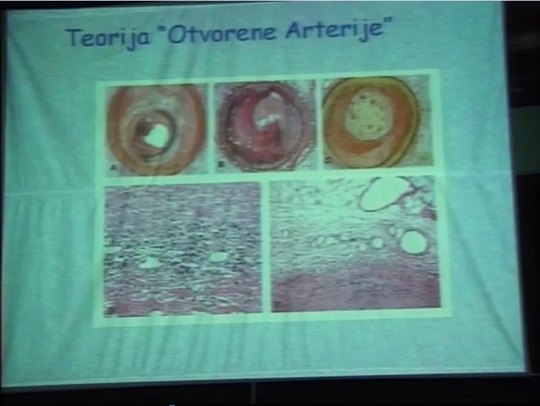 Kasna rekanalizacija okludirane infarktne arterije