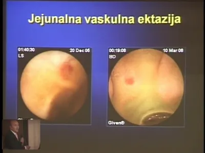 Uloga endoskopske videokapsule u otkrivanju uzroka krvarenja iz tankog creva