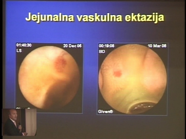 Uloga endoskopske videokapsule u otkrivanju uzroka krvarenja iz tankog creva