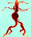 Aneurizme abdominalne aorte i ilijačnih arterija