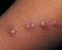 Bolest mačjeg ogreba (Cat schratch disease)