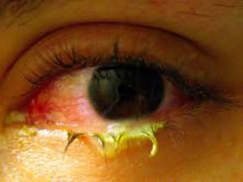 Inkluzorni konjuktivitis, uzročnik Chlamydia trachomatis