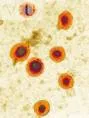 Mumps meningitis