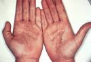 Tinea nigra